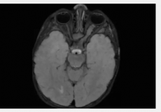 癫痫药物可预防NF1小鼠脑肿瘤